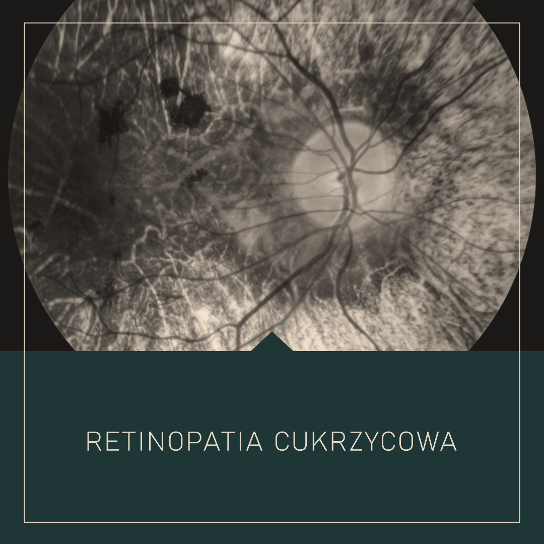 Retinopatia Cukrzycowa